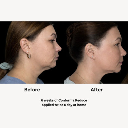 Conforma Reduce
